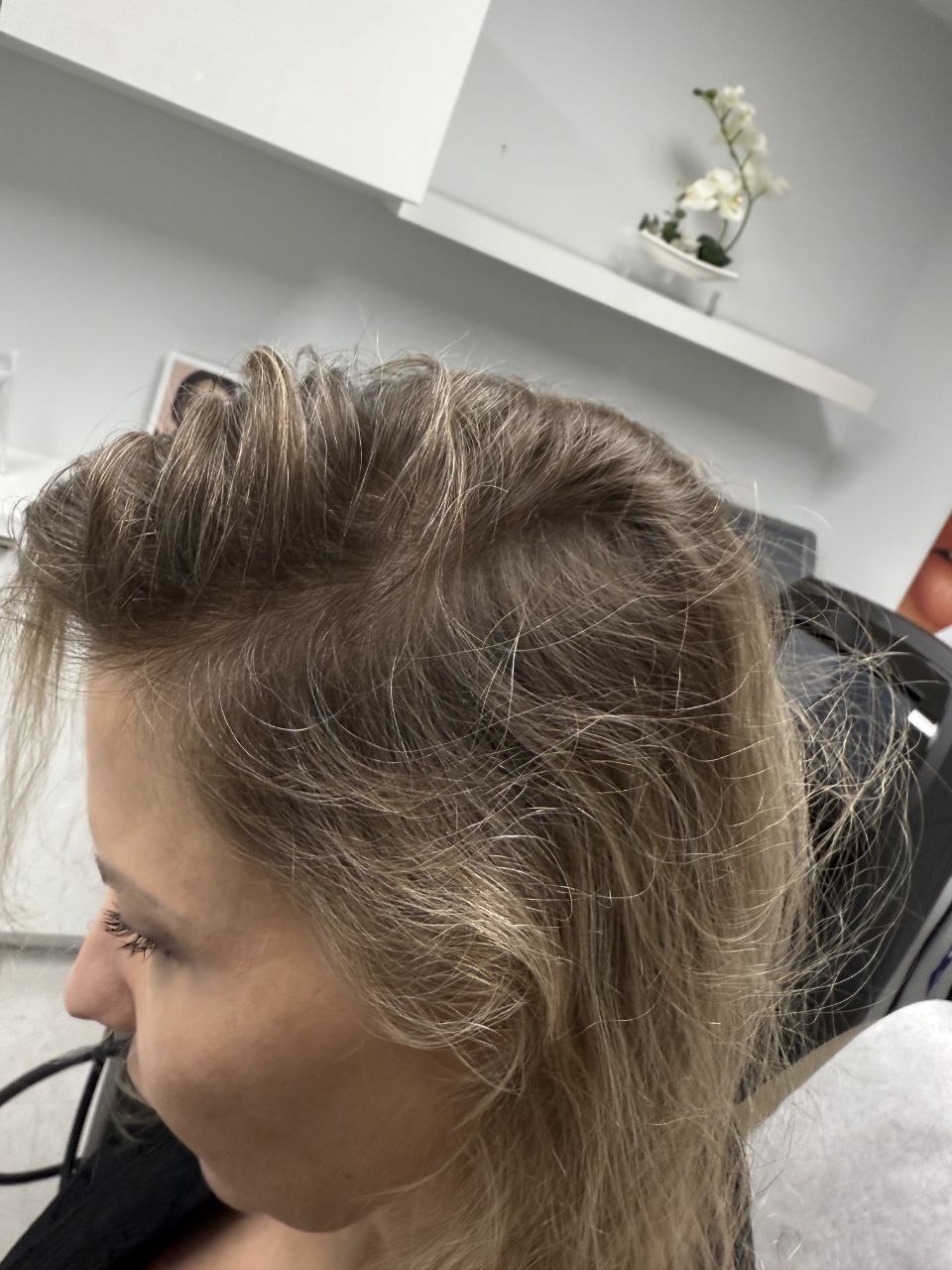 After treatment — hairline regrowth